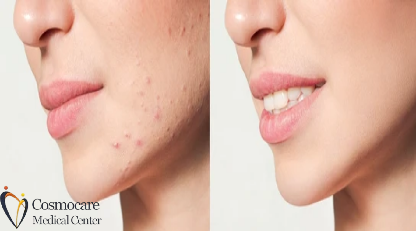   Acne Scar Treatment In Dubai   by Cosmocare Medical Center