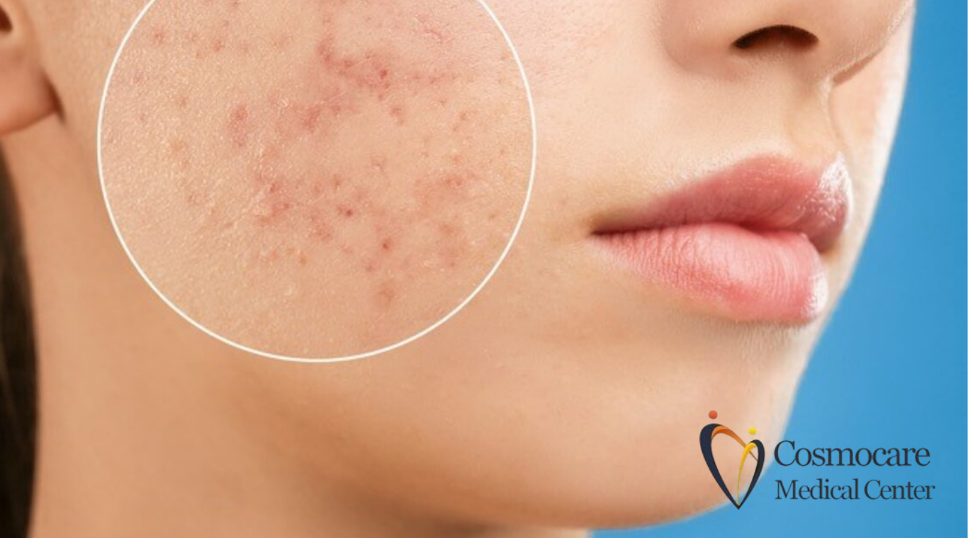 Acne Treatment in Dubai by Cosmocare Medical Center