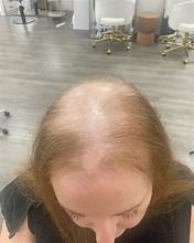 Expert Alopecia Treatments in Dubai