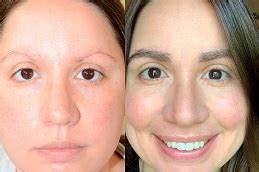 Expert Alopecia Treatments in Dubai