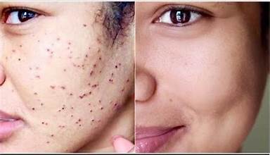 Facial Wart Removal Specialist in Dubai at Cosmocare Medical Center