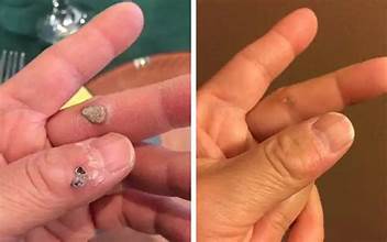 Warts Treatment