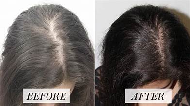 Best Dermatologist for Hair Loss in Dubai