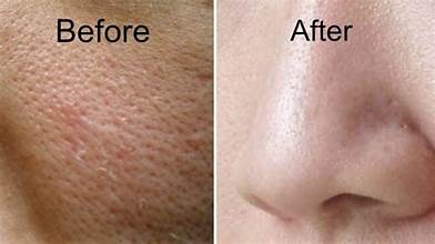 Large Pores Treatment in Dubai by Dr. Murtuza Bandukwala at Cosmocare Medical Center