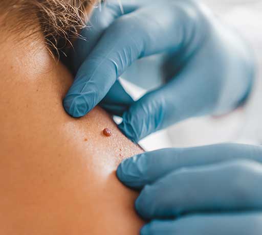 Expert Mole Removal Treatments in Dubai