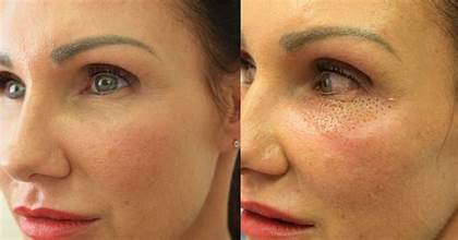 Plasma Lift Treatment in Dubai by Dr. Murtuza Bandukwala - Cosmocare Medical Center