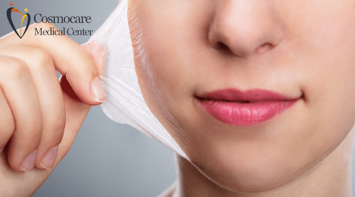 Dermamelan Chemical Peel Treatment Dubai by Cosmocare Medical Center