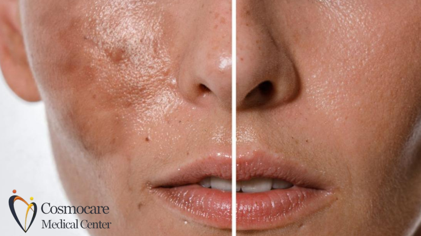 Freckles And Blemishes Treatment In Dubai by Cosmocare Medical Center