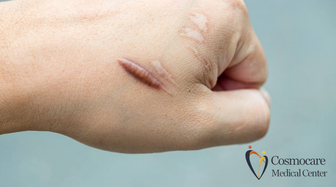 Keloid Scars Treatment In Dubai by Cosmocare Medical Center