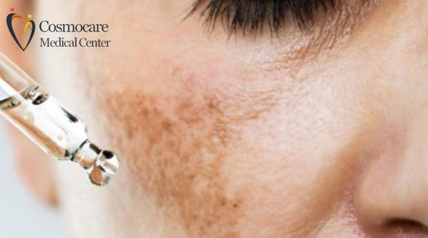 Skin Hyperpigmentation Treatment In Dubai by Cosmocare Medical Center
