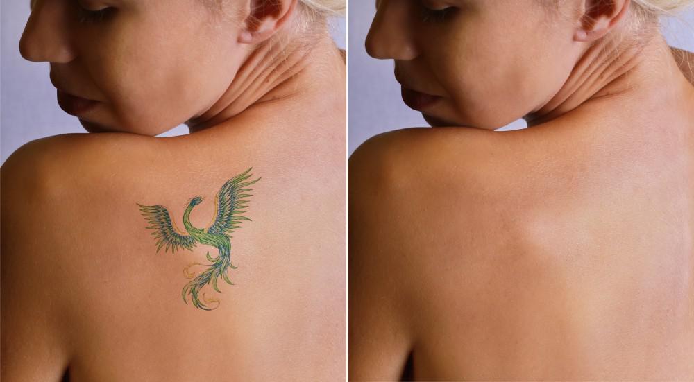 tattoo removal laser dubai