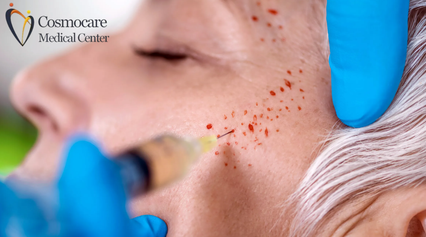 Vampire Facial Treatment in Dubai by Cosmocare Medical Center